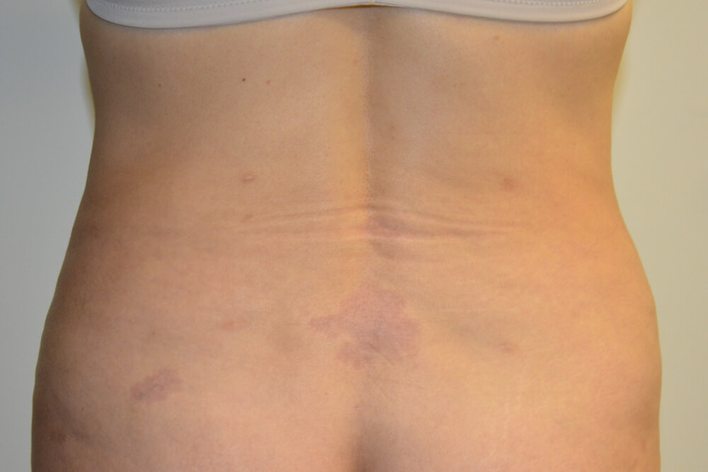 Liposuction-07 | After Liposuction 2