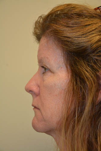 Eyelid-Surgery-10 | Before Eyelid Surgery 5