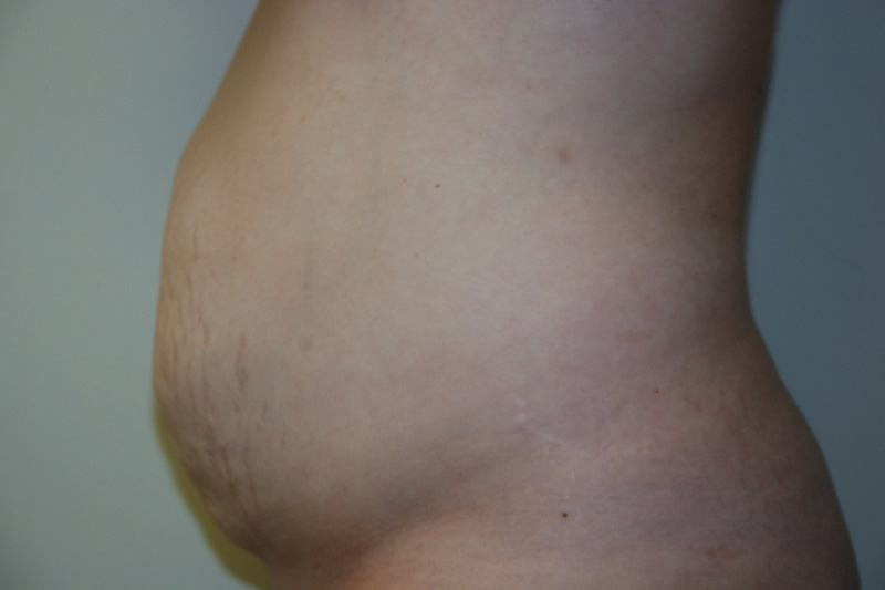 Tummy-Tuck-13 | Before Tummy Tuck 5
