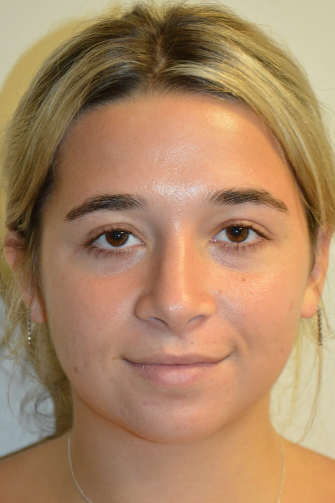 Rhinoplasty-09 | After Rhinoplasty 5