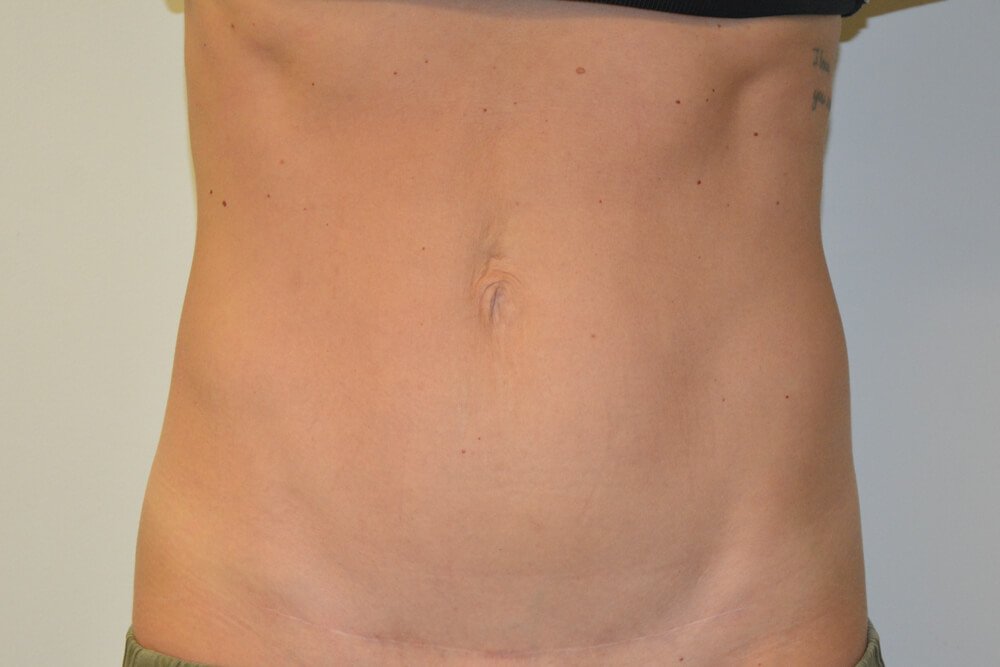 Mini-Tummy-Tuck-09 | After Mini Tummy Tuck 1