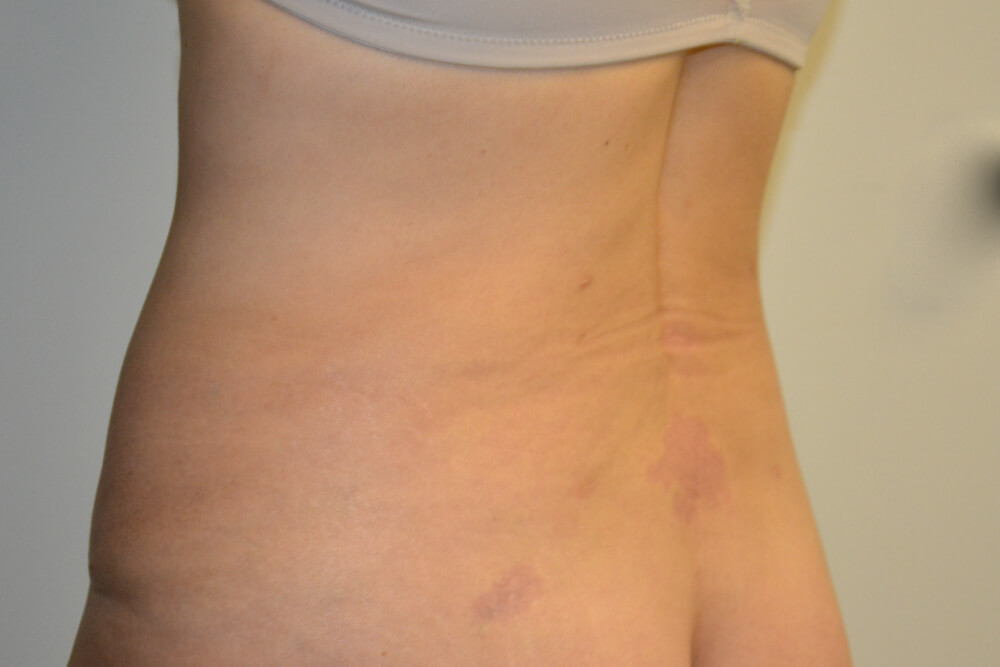 Liposuction-07 | After Liposuction