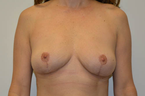 Implant-Removal-08 | After Implant Removal