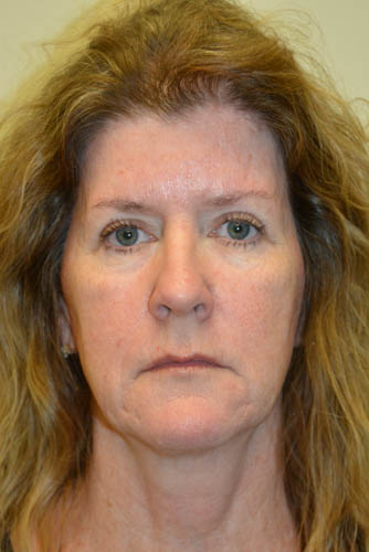 Eyelid-Surgery-10 | After Eyelid Surgery 1