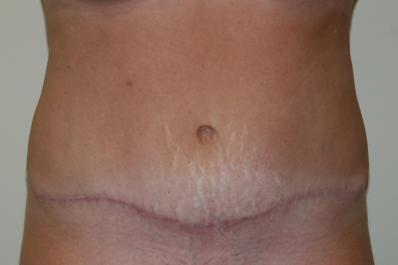 Tummy-Tuck-13 | After Tummy Tuck