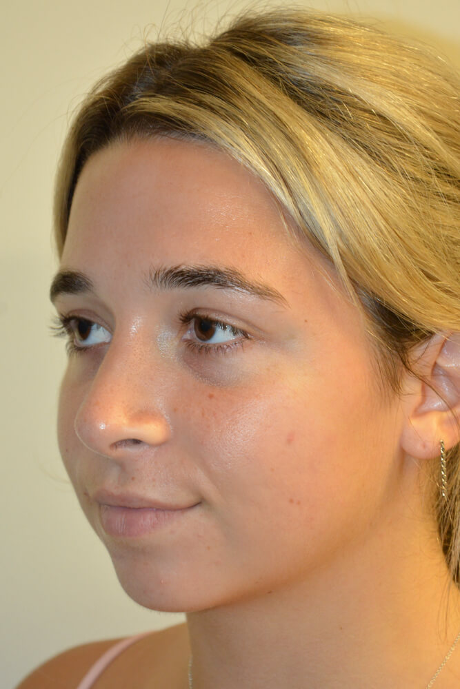 Rhinoplasty-09 | After Rhinoplasty 2