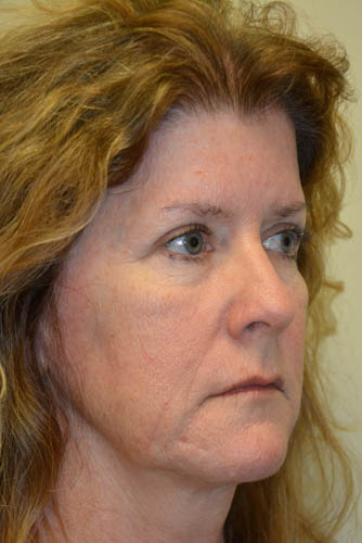 Eyelid-Surgery-10 | After Eyelid Surgery 2