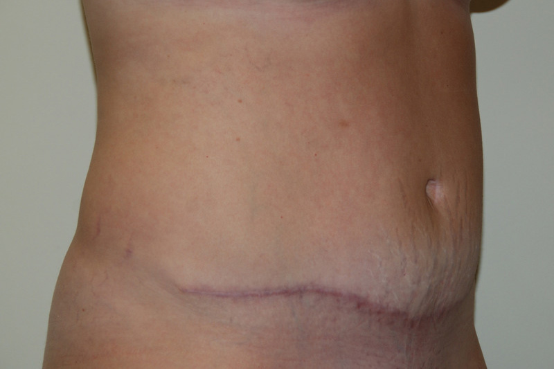 Tummy-Tuck-13 | After Tummy Tuck 2