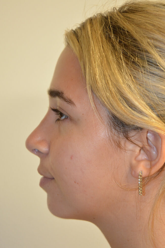 Rhinoplasty-09 | After Rhinoplasty