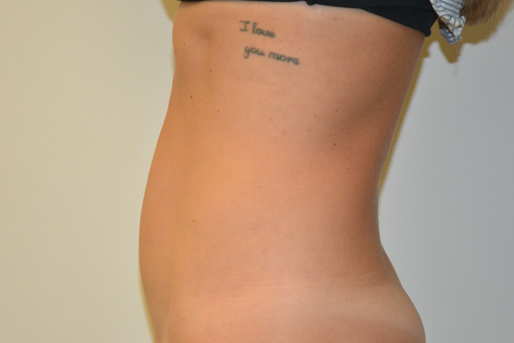 Mini-Tummy-Tuck-09 | After Mini Tummy Tuck 5