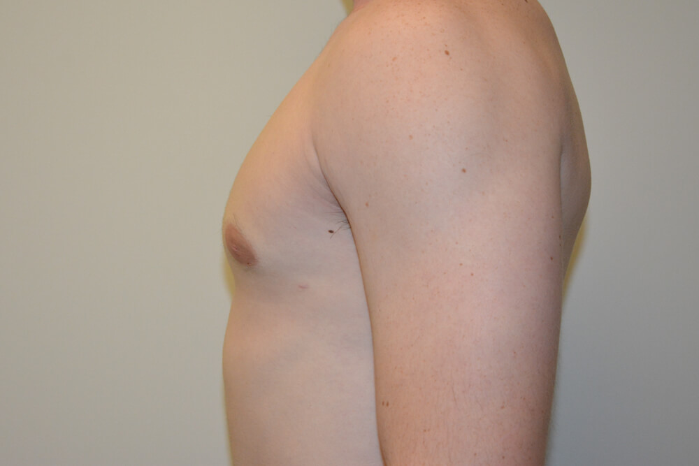 Male-Breast-Reduction-09 | After Male Breast Reduction 5