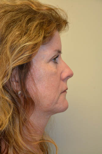 Eyelid-Surgery-10 | After Eyelid Surgery 3
