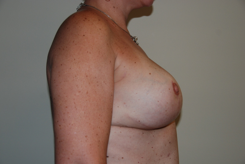 Breast-Reconstruction-Tissue-Expander-09 | After Breast Reconstruction Tissue Expanders 3