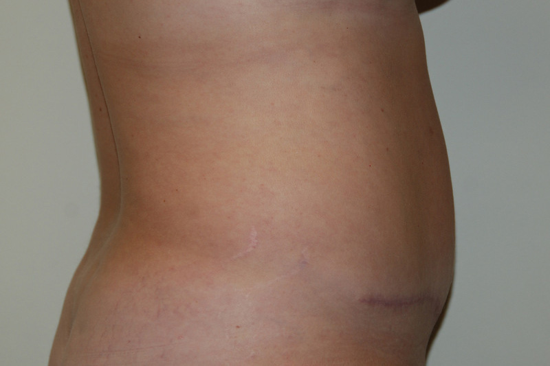 Tummy-Tuck-13 | After Tummy Tuck 3