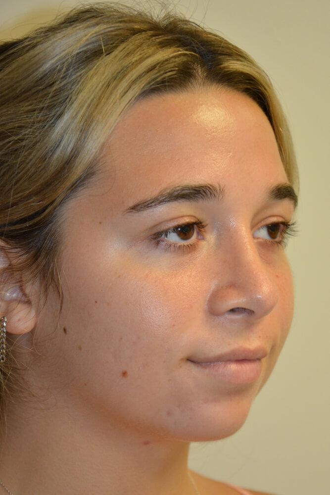 Rhinoplasty-09 | After Rhinoplasty 4
