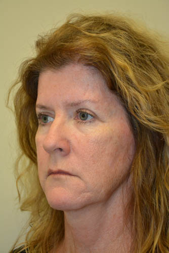 Eyelid-Surgery-10 | After Eyelid Surgery 4