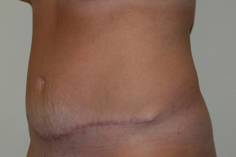 Tummy-Tuck-13 | After Tummy Tuck 4