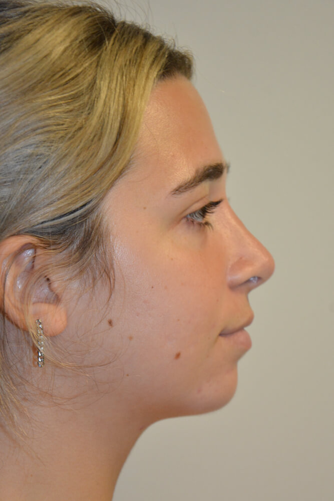 Rhinoplasty-09 | After Rhinoplasty 3