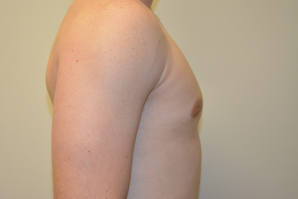 Male-Breast-Reduction-09 | After Male Breast Reduction 3