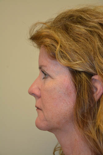 Eyelid-Surgery-10 | After Eyelid Surgery 5