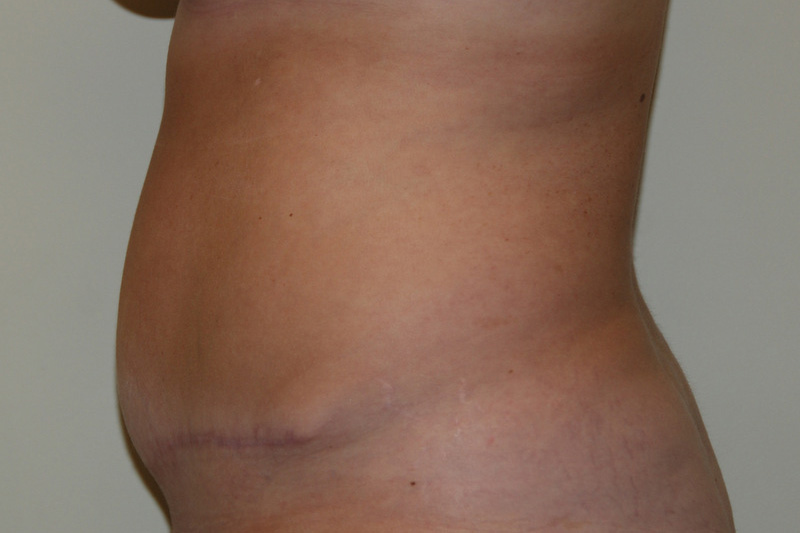 Tummy-Tuck-13 | After Tummy Tuck 5