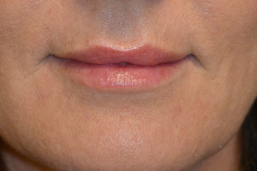 Injectable-Fillers-01 | After Injectable Fillers