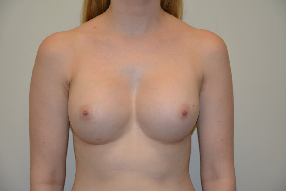 Breast-Augmentation-10 | After Breast Augmentation