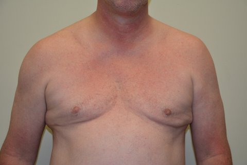 Male-Breast-Reduction-02 | After Male Breast Reduction