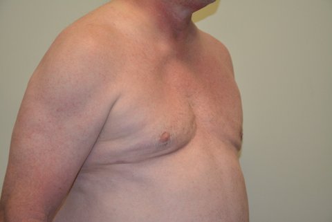 Male-Breast-Reduction-02 | After Male Breast Reduction 3