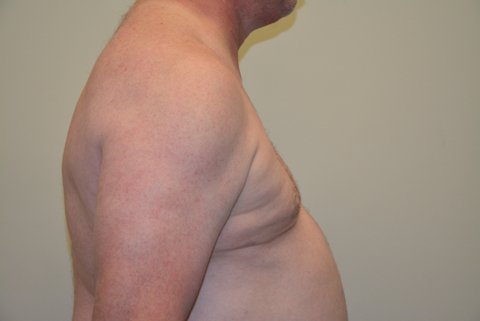 Male-Breast-Reduction-02 | After Male Breast Reduction 5