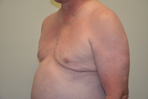 Male-Breast-Reduction-02 | After Male Breast Reduction 2