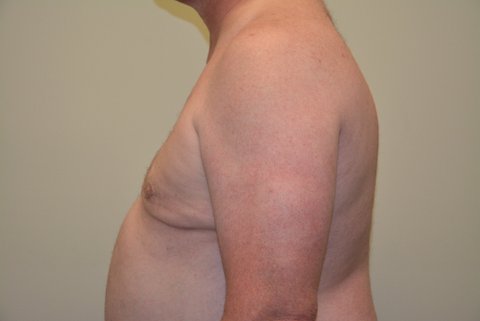 Male-Breast-Reduction-02 | After Male Breast Reduction 4