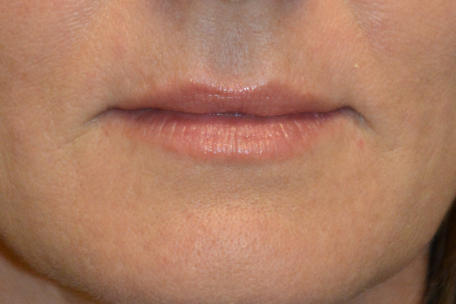 Injectable-Fillers-01 | Before Injectable Fillers