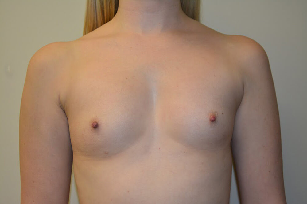 Breast-Augmentation-10 | Before Breast Augmentation