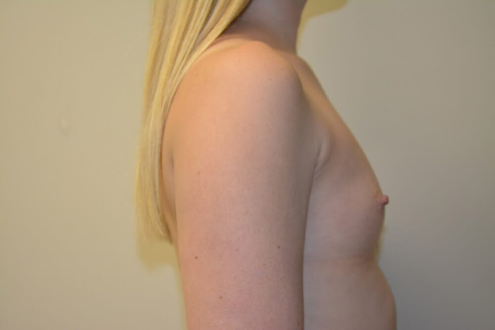 Breast-Augmentation-10 | Before Breast Augmentation 3