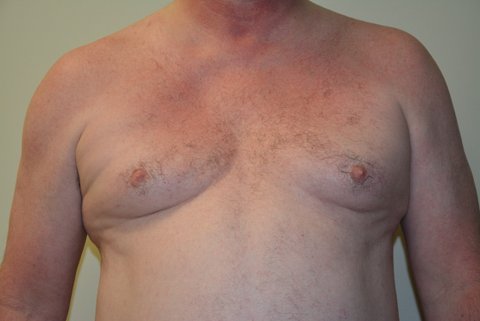Male-Breast-Reduction-02 | Before Male Breast Reduction