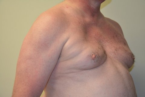 Male-Breast-Reduction-02 | Before Male Breast Reduction 3