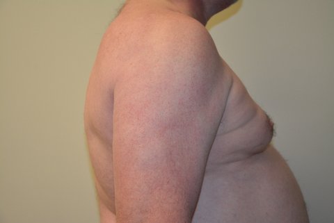 Male-Breast-Reduction-02 | Before Male Breast Reduction 5