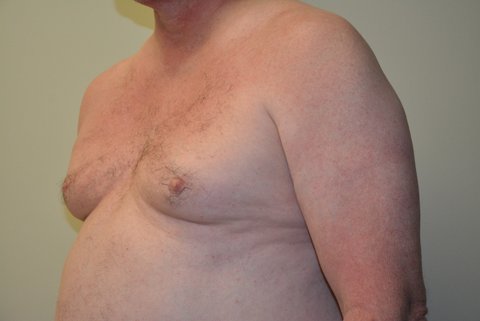 Male-Breast-Reduction-02 | Before Male Breast Reduction 2