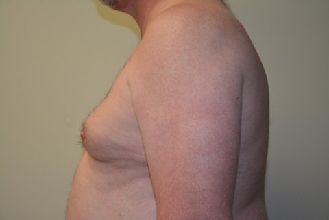 Male-Breast-Reduction-02 | Before Male Breast Reduction 4