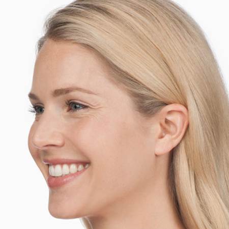 Botox---Cosmetic-01 | Before Botox® Cosmetic 2