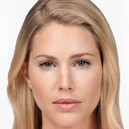 Botox---Cosmetic-01 | After Botox® Cosmetic