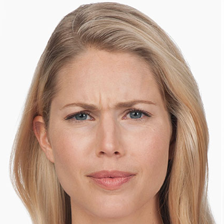 Botox---Cosmetic-01 | Before Botox® Cosmetic