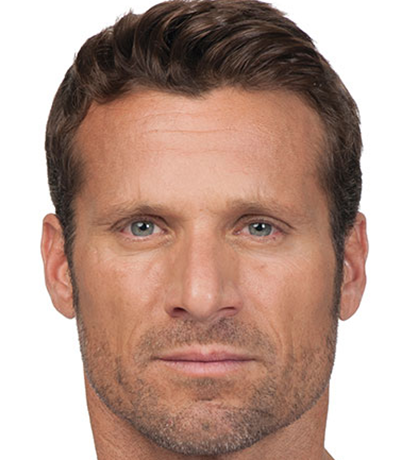Botox---Cosmetic-02 | After Botox® Cosmetic