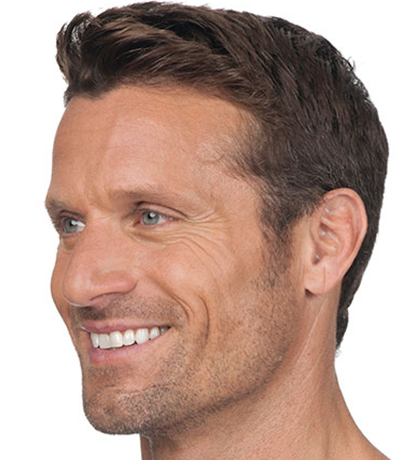 Botox---Cosmetic-02 | Before Botox® Cosmetic 2