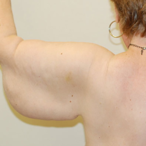 Arm-Lift-01 | Before Arm Lift 2