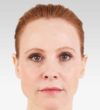 Injectable-Fillers-02 | After Injectable Fillers