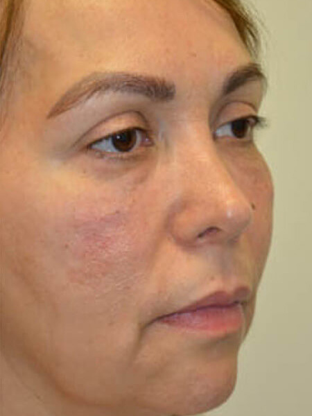 Injectable-Fillers-05 | After Injectable Fillers 3