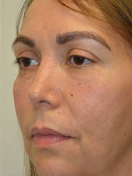 Injectable-Fillers-05 | After Injectable Fillers 2