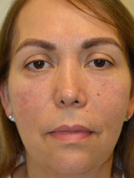 Injectable-Fillers-05 | After Injectable Fillers